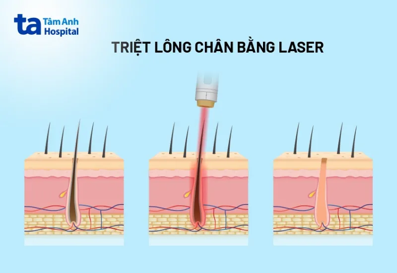 ảnh minh họa triệt lông chân bằng laser