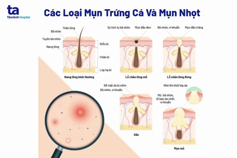 mụn ẩn là gì