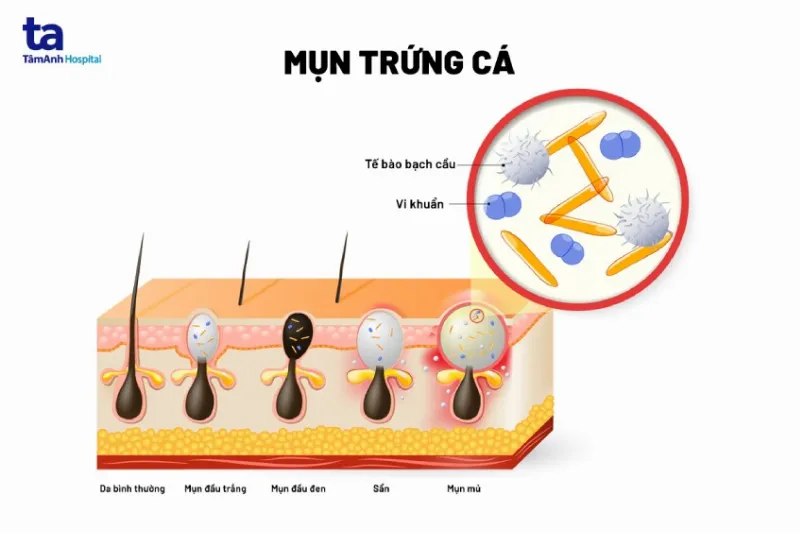 mụn trứng cá là gì