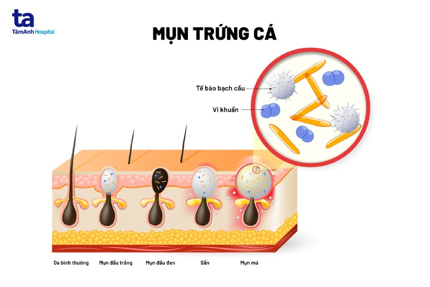 mun trung ca la gi