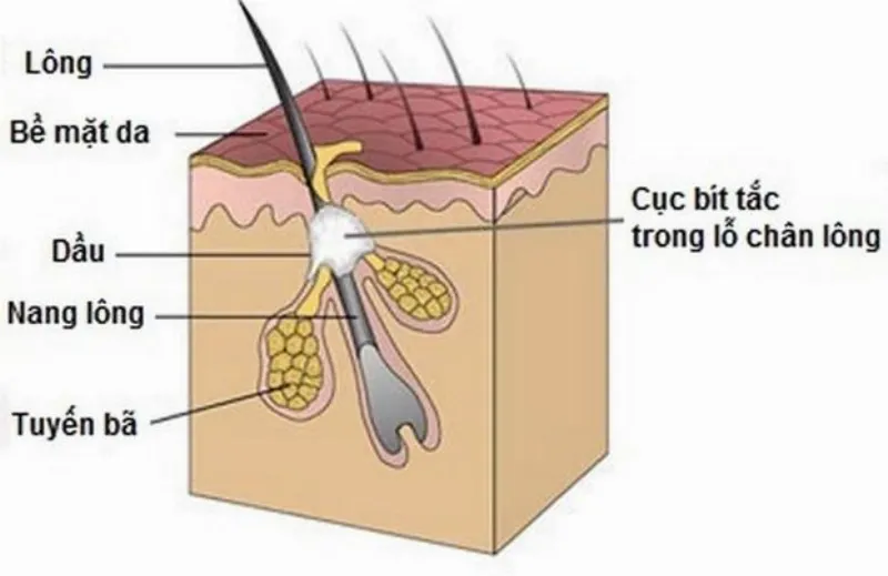 Tắc lỗ chân lông