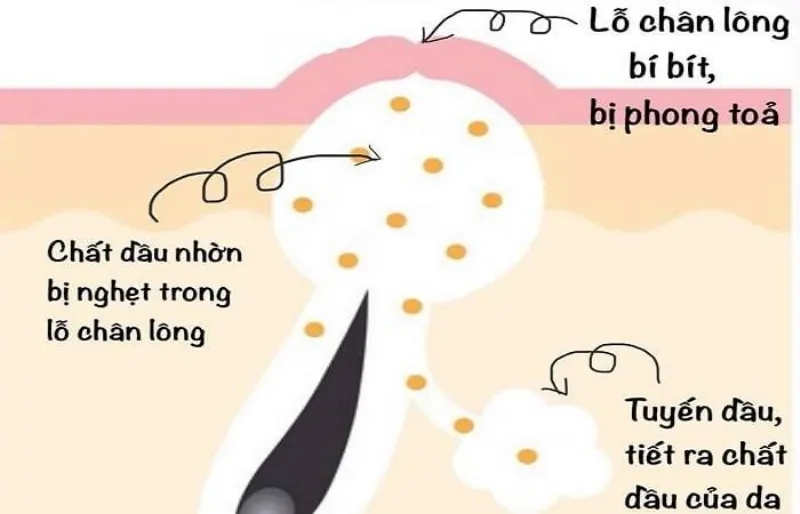 Vì sao da dầu thường xuyên bị nổi mụn